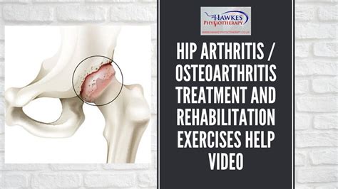 Hip arthritis / osteoarthritis treatment and rehabilitation exercises ...