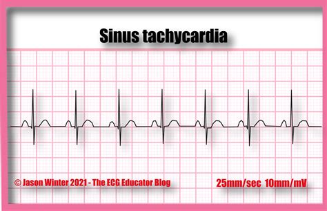 Supraventricular Tachycardia Rhythm Strip