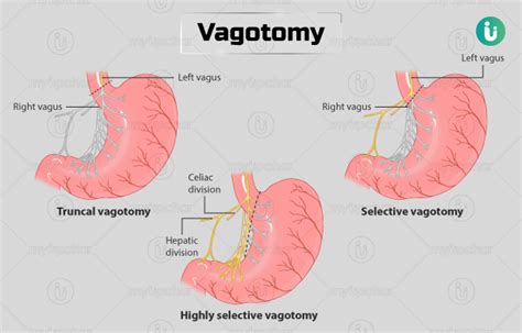 Figure 70-1 From Surgery Of Duodenal Semantic Scholar, 58% OFF