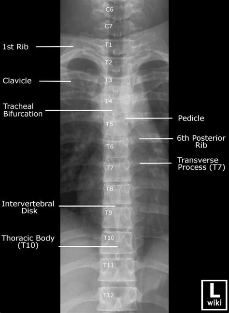 Thoracic Spine X Ray Labeled - cloudshareinfo