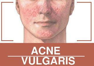 Acne Vulgaris Causes and Prevention - primary health care News