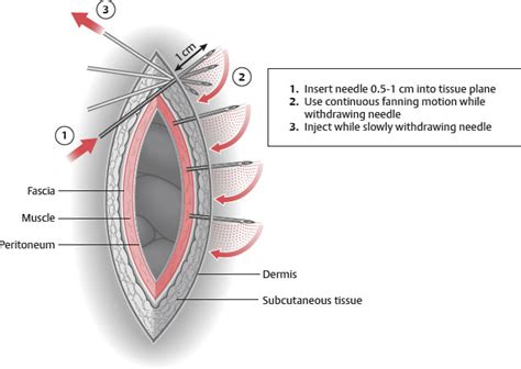 8. Multimodal Analgesia for the Aesthetic Surgery Patient | Plastic Surgery Key