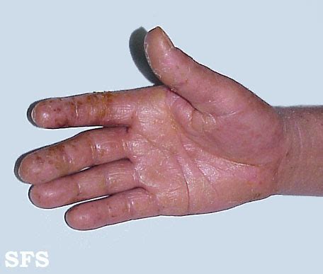 Palm Skin Rash Types, Causes, Pictures, Treatment | Healthhype.com