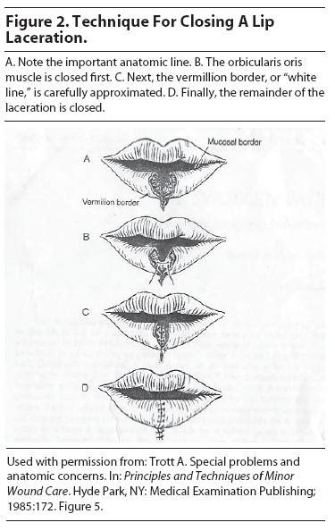 Lip lacerations Q&A – PEMBlog