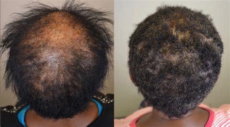 Medical therapy for central centrifugal cicatricial alopecia - Hair Restoration of the South