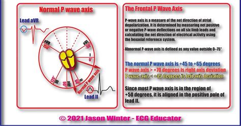 ECG Educator Blog : P axis on an ECG