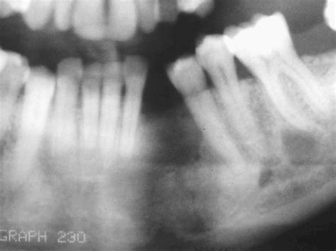 Peripheral Ossifying Fibroma Radiograph