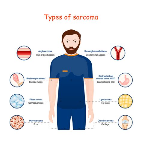 Soft Tissue Sarcoma - Travocure