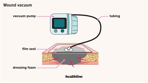 Wound VAC Process, Benefits, Side Effects, Complications, and Cost