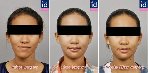 ID Hospital Korea: Crooked jaw, protruding jaw can be corrected through ...