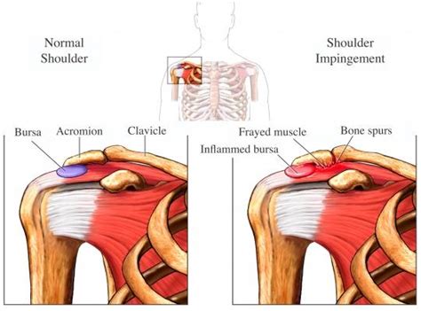 What is Shoulder Impingement - Dr. Roger Chams