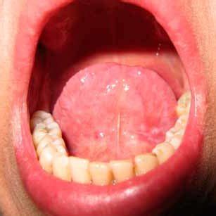 a: White light image of the leukoplakia on the ventrum of the tongue ...