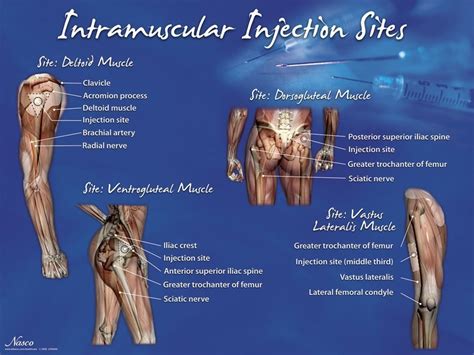 Intramuscular Injection Sites Poster | Intramuscular injection sites, Im injection, Im injection ...