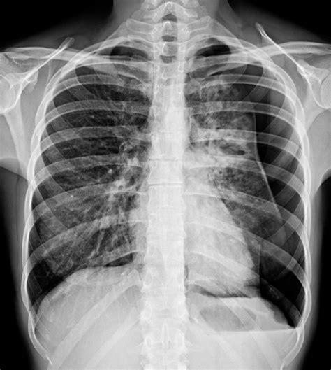 Pneumothorax Chest X Ray