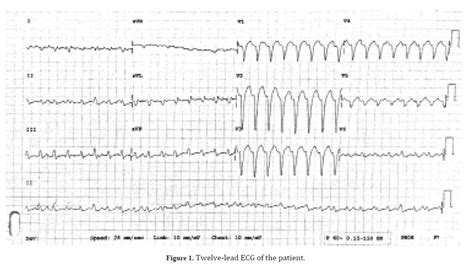 Narrow QRS Complex Tachycardia