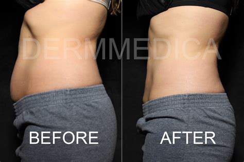 Coolsculpting: Before/After Photos | DermMedica