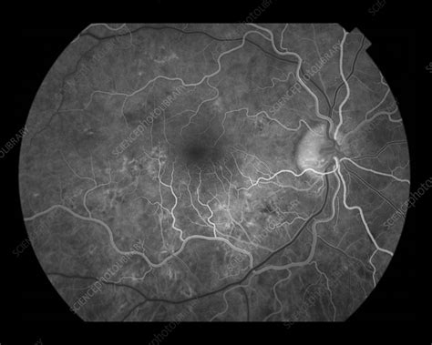 Multifocal Choroiditis - Stock Image - C027/1329 - Science Photo Library