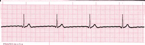 ekg