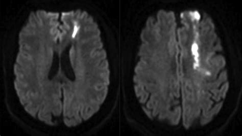 Ischemia in Broca Area Is Associated With Broca Aphasia More Reliably ...