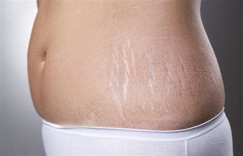 Bio Oil Review And Benefits: How To Use Bio-Oil For Stretch Marks?