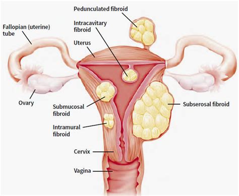 Gynae Laparoscopy Malaysia | What are fibroids?