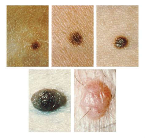 Common Moles, Dysplastic Nevi, and Risk of Melanoma - National Cancer Institute