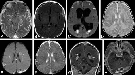 Bacterial Meningitis Brain Mri