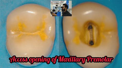 Access opening of Maxillary Premolar# step by step root canal demonstration#rct for beginners ...