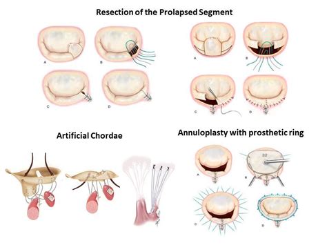 Mitral Valve Repair