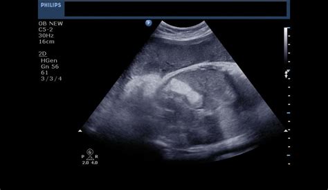 Ultrasound imaging: Echogenic Fetal bowel-an intriguing case