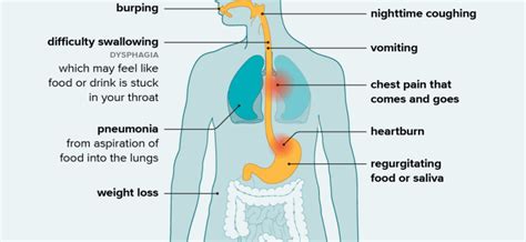 Esophageal Achalasia – Causes, Symptoms, Treatment – Healthy Food Near Me