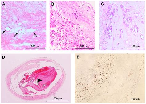 | Progressive atherosclerotic lesions. Pathological intima thickening... | Download Scientific ...