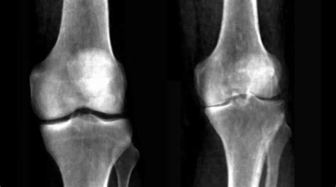 AI Tech Accurately Diagnoses Knee Arthritis from Medical Images | Dell ...