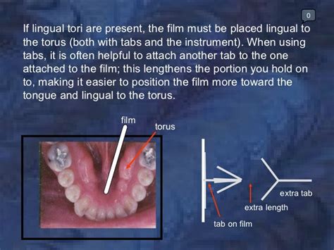 radiology-bitewing-technique