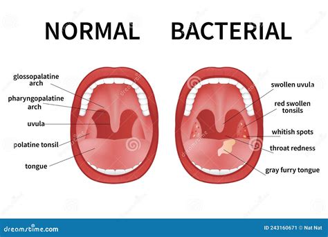 Angina, Pharyngitis, And Tonsillitis. Tonsil Infection. Open Mouth. Stock Photography ...