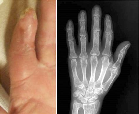 Figure 3 from Salvage Therapy from Traumatic Ischemic Finger Necrosis via Prostaglandin E1 ...