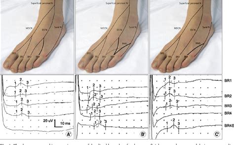 Nerve Conduction Study Video