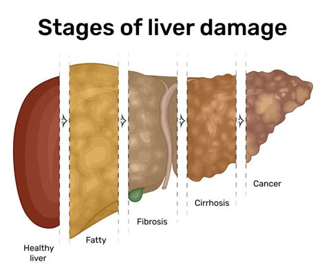 Understanding Fatty Liver Disease – Kmh Health blog