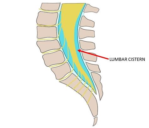 Lumbar Cistern