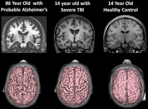 Volumetric neuroimaging and traumatic brain injuries - Cortechs.ai