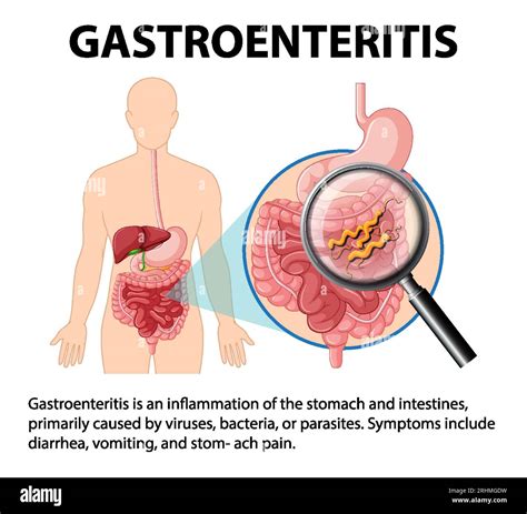 An infographic illustrating gastroenteritis, its causes, and symptoms ...