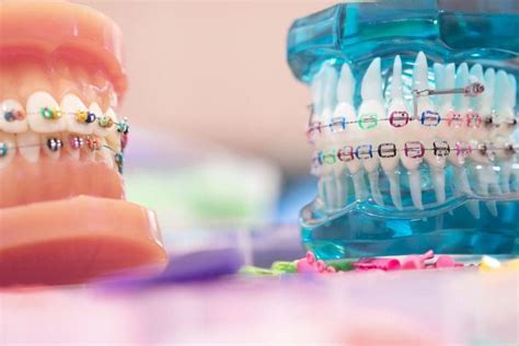 How to Choose the Best Braces Colors - Superior Care OrthodonticsOrthodontist Tulsa, OK ...