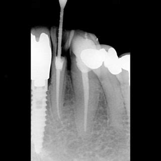 Complications in Root Canal Treatment - Dr Sunil Dental Blog