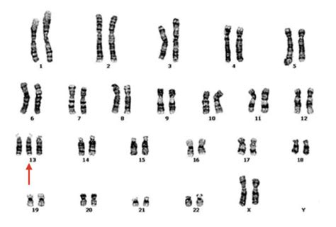 Trisomy 13(Patau Syndrome)- Definition, Causes, Symptoms, Life Expectancy And Diagnosis