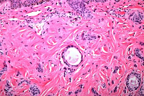 Pathology Outlines - Syringoma