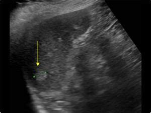 WK 5 SPLEEN PATHOLOGY Splenic hemangiomas | Ultrasound sonography, Diagnostic medical sonography ...