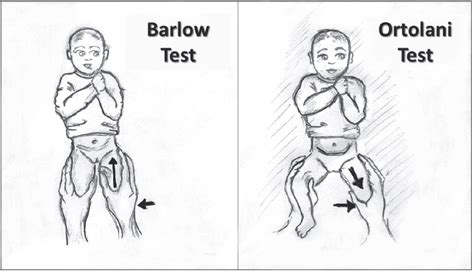 What is the Barlow Test and How is it Performed? - Heal Cure