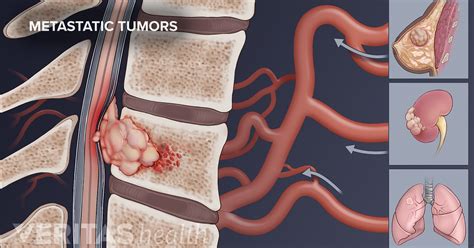 Metastatic Spine Tumors