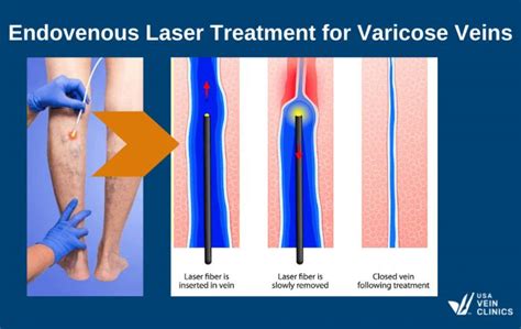 Varicose Vein Removal And Surgery | USA Vein Clinics