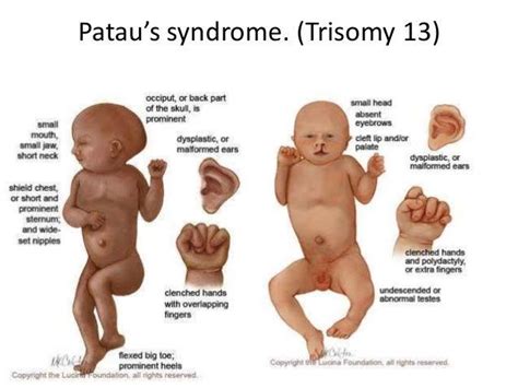 Patau Syndrome - Symptoms, Causes, Diagnosis & Treatment - Santripty